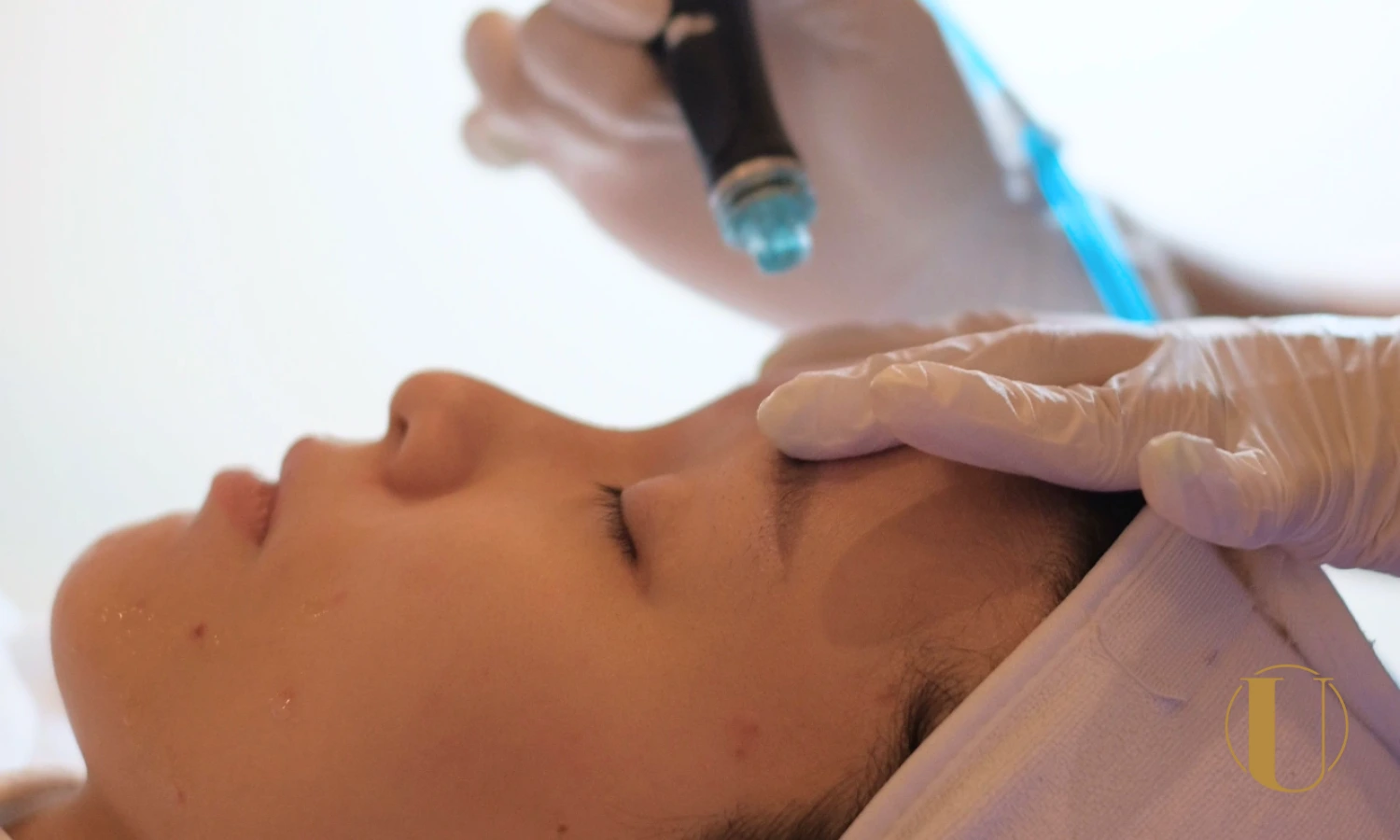 Hydrafacial in Singapore for deep cleansing, exfoliation and glow at U Aesthetics