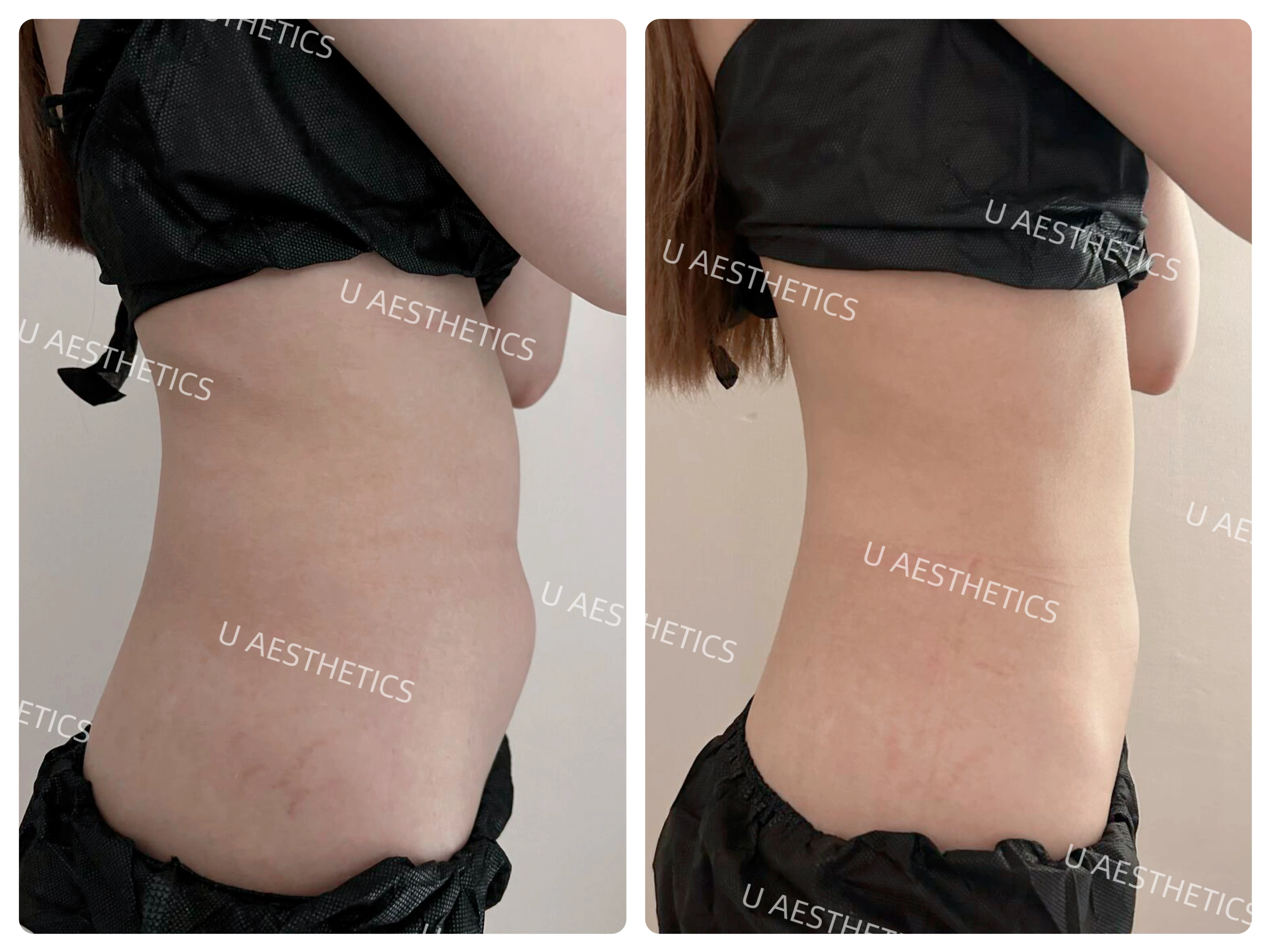 Onda Pro Real Before After Results in Singapore