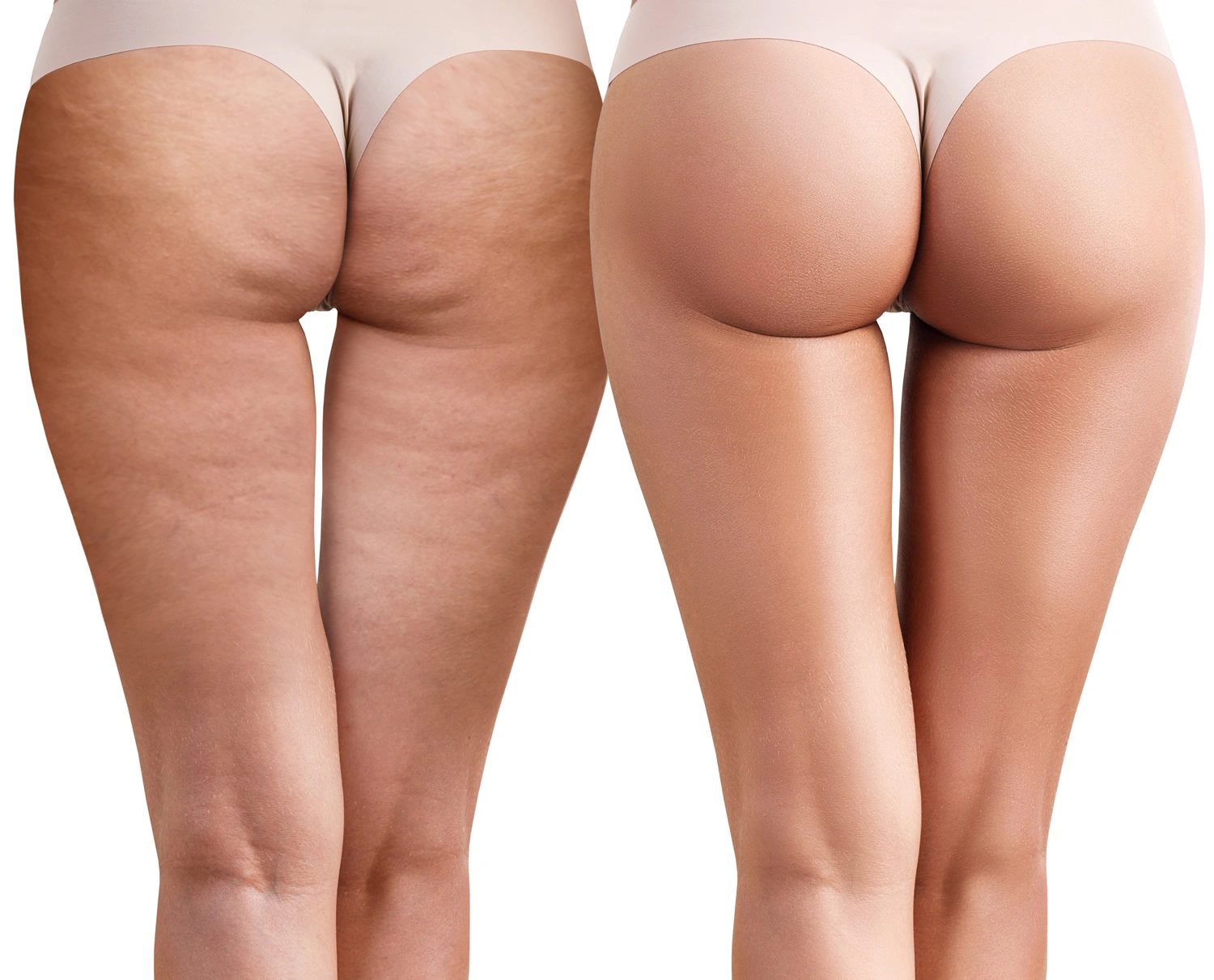 Cellulite on thighs and buttocks example