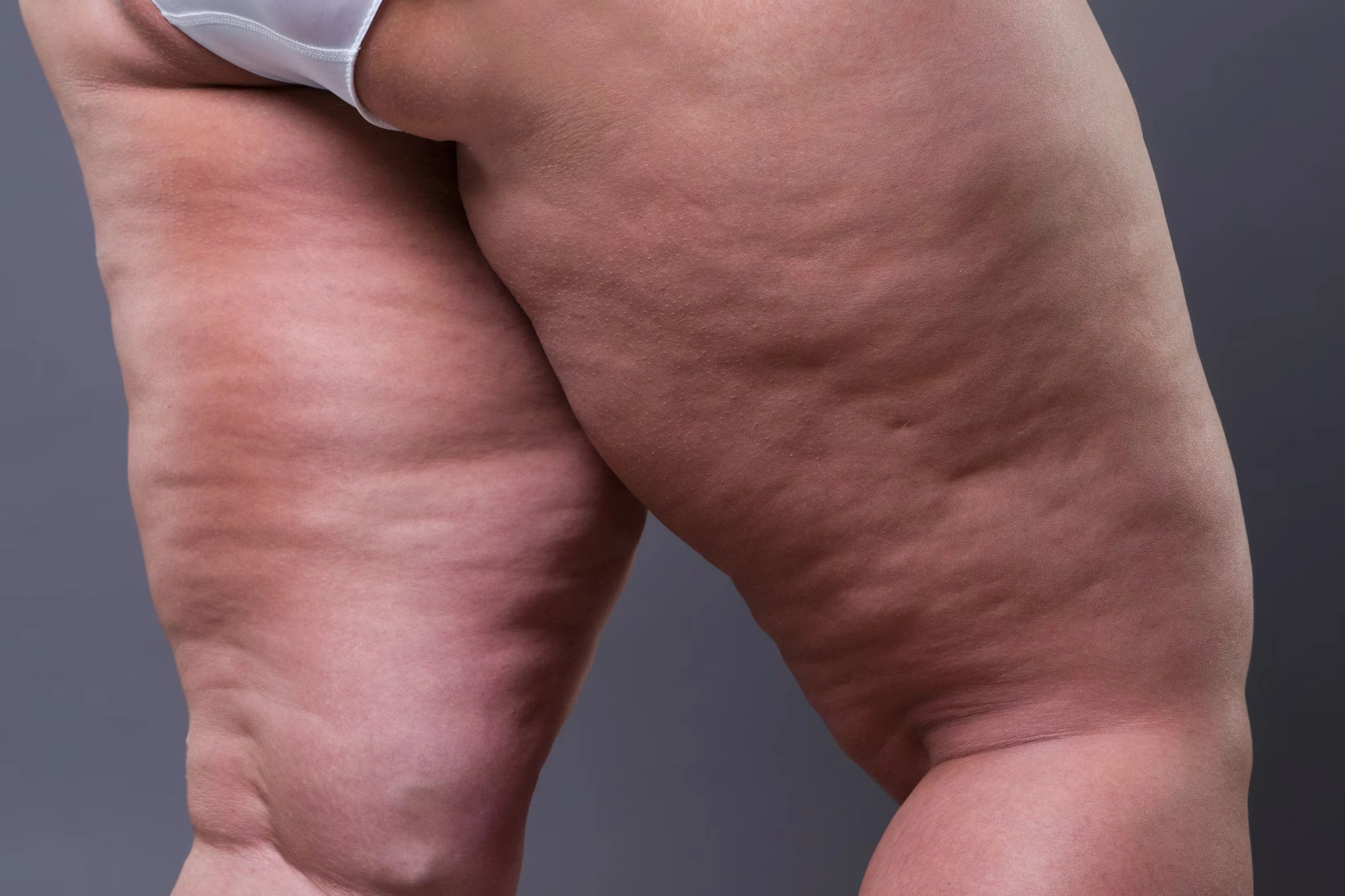 Severe cellulite