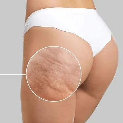 Close-up of cellulite on skin