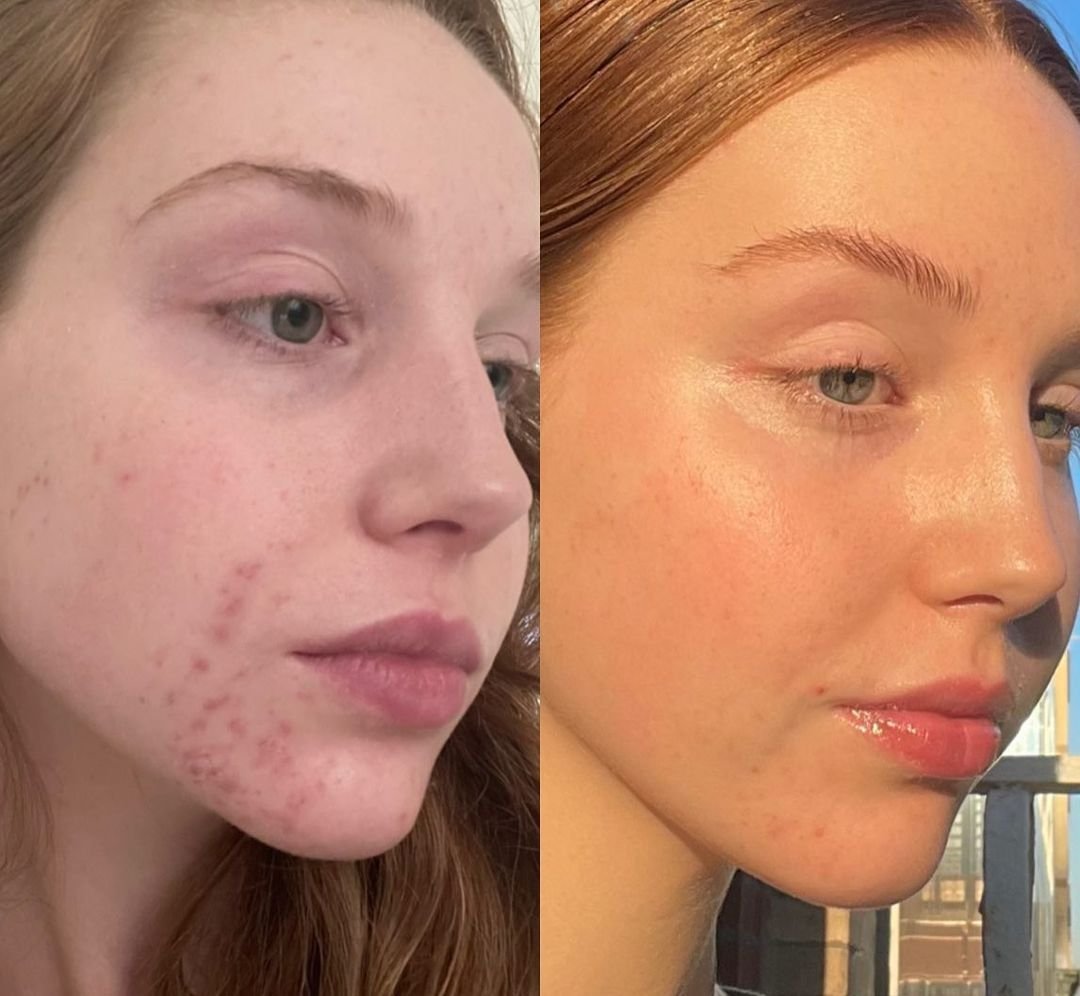 Hydrafacial Treatment