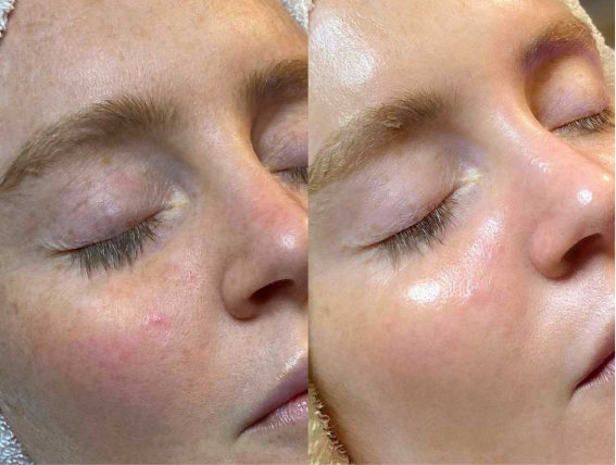 Hydrafacial Treatment
