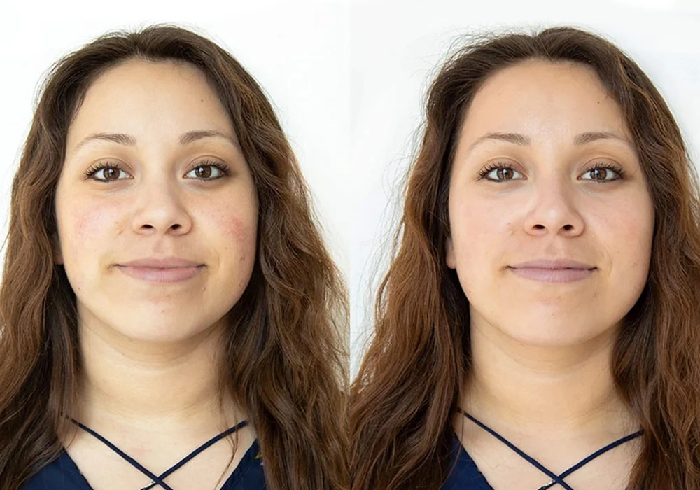 U Aesthetics Medispa Hydro Facial