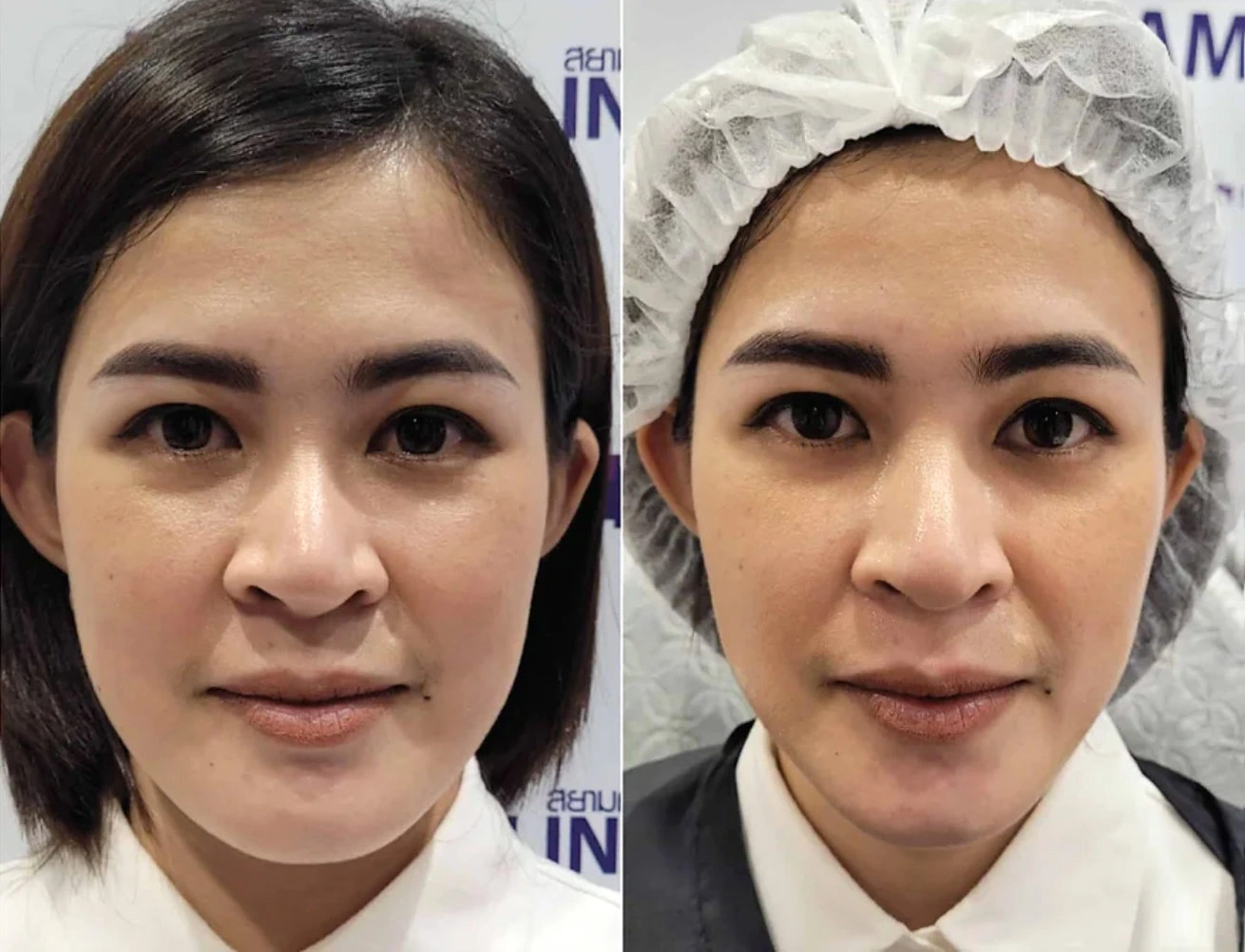 U Aesthetics V Shape Face